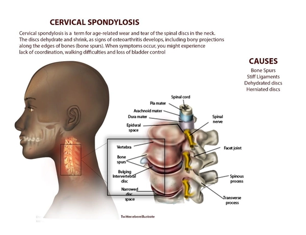 Illustration of Cervical Spondylosis