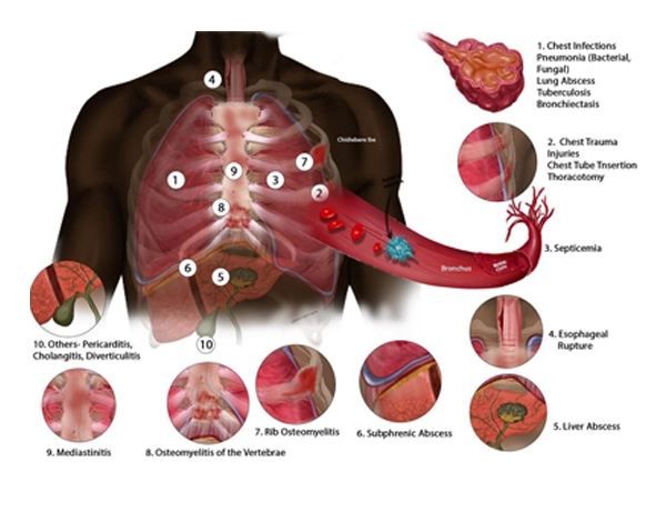 Chidibere Ibe Illustration of Chest Infections on African American
