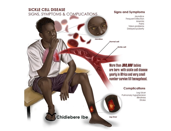 Illustration of Sickle Cell Disease on African American boy. Chidiebere Ibe